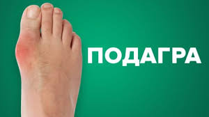 Подагра – хвороба королів та аристократів