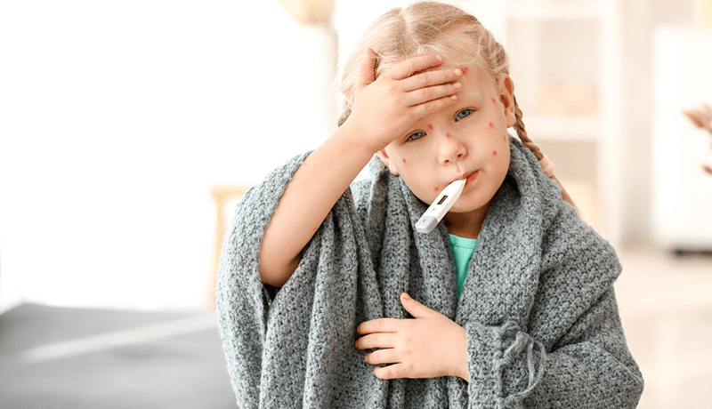 Вітряна віспа: шляхи передачі, симптоми та профілактика